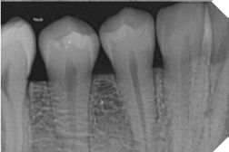 Sensor Intraoral I View