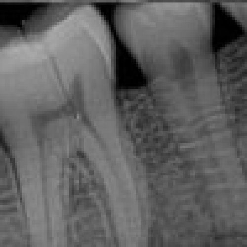 Sensor Intraoral I View