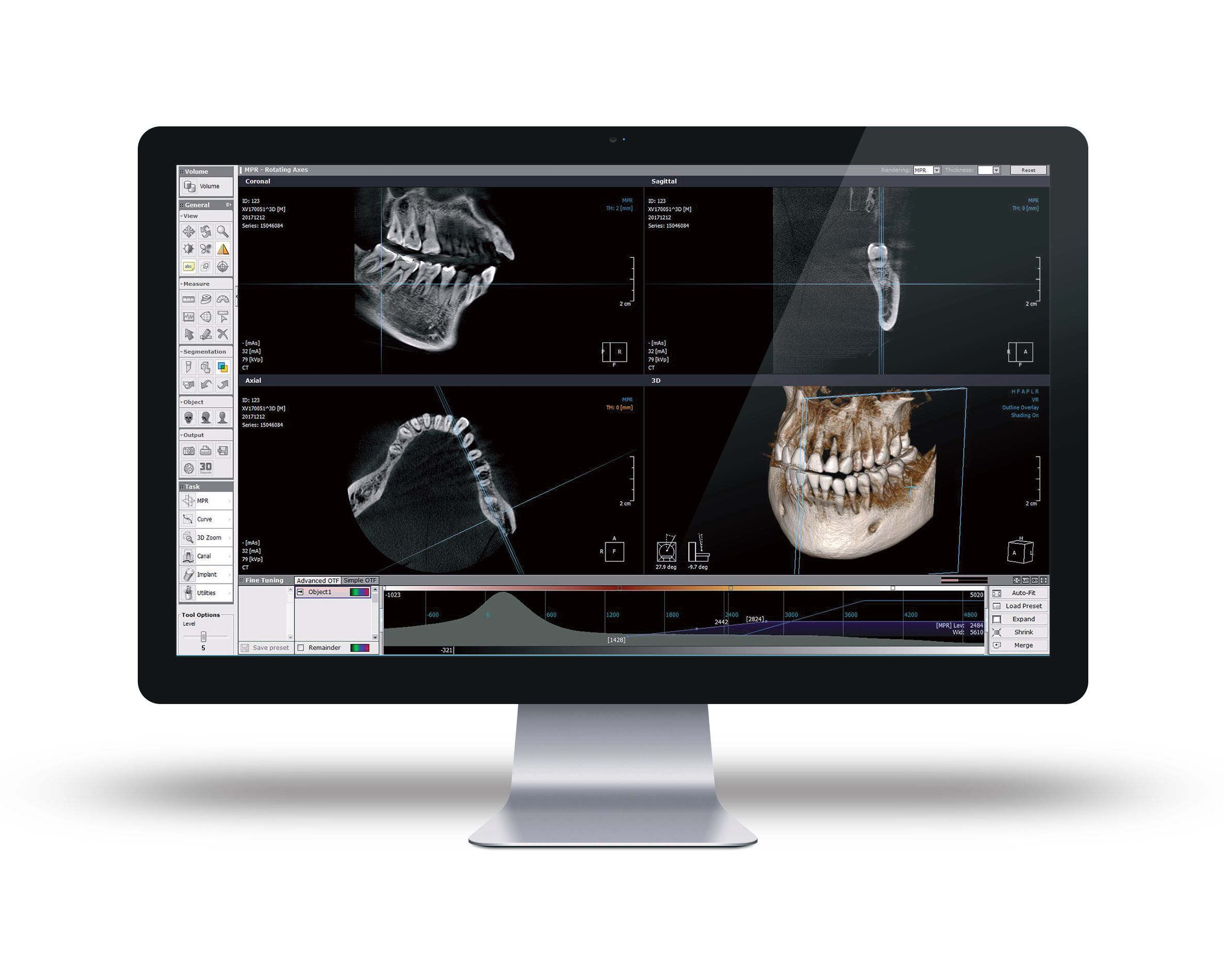 Xelis Dental. Software para Planificación de Implantes ASVADENT
