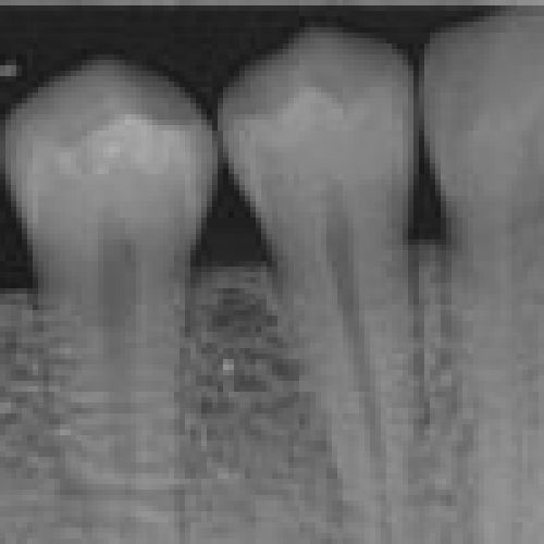 Sensor Intraoral I View