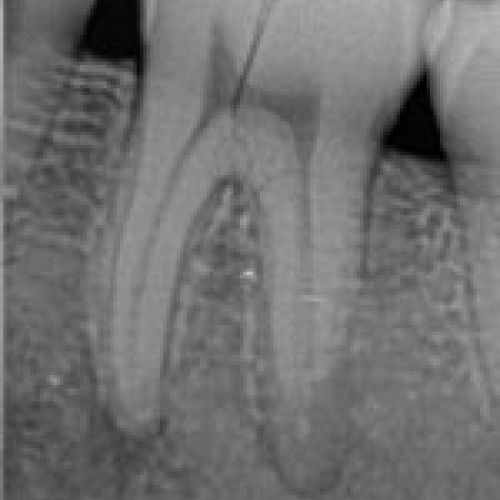 Sensor Intraoral I View