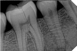 Sensor Intraoral I View