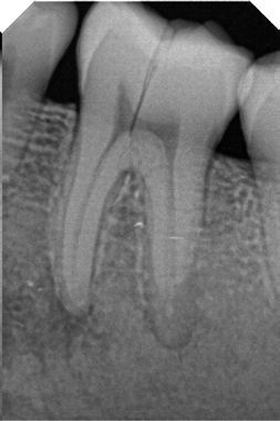 Sensor Intraoral I View